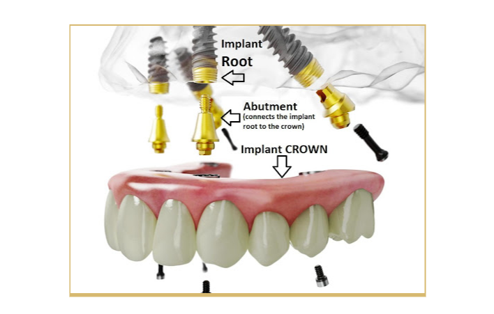 All On Dental Implants Cost Understanding The Cost Of All On