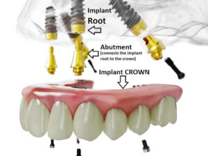 Most popular types of dental implants