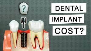 Dental Implant Cost and Payment Plans for Dental Implants – Chicago ...