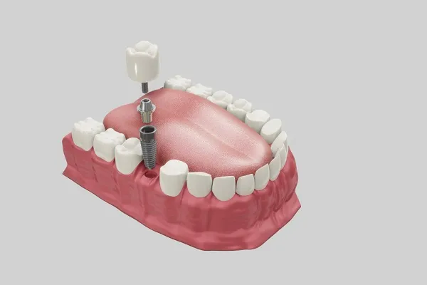 Most Popular Types of Dental Implants