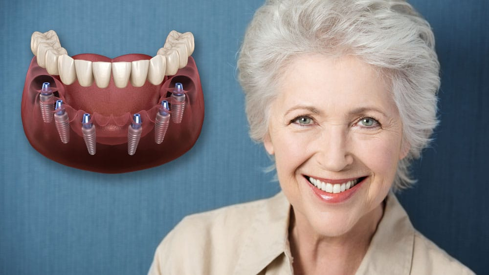 Dental Implants in Mexico is it safe to get dental implants in mexico