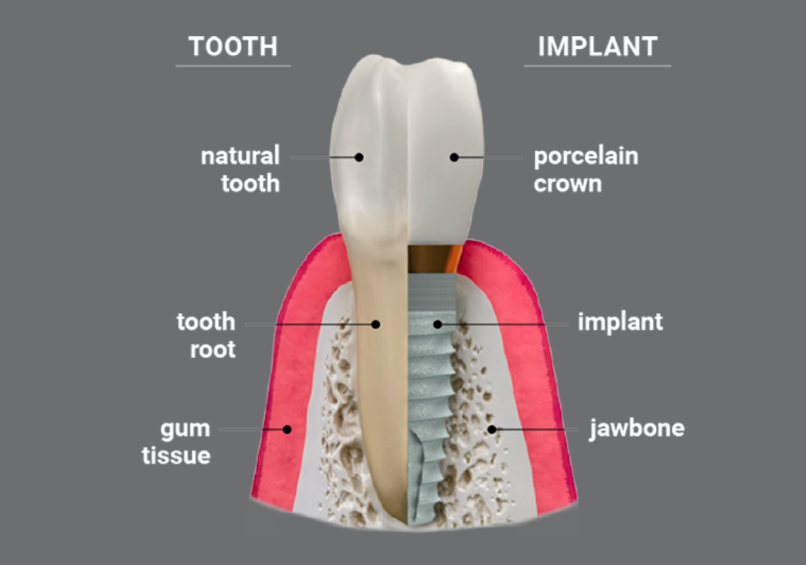 What Are Dental Implants and Why They Became the Best Tooth Replacement