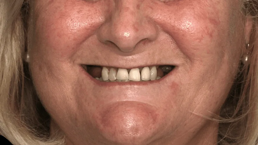 photo-11-aabefore-1-2